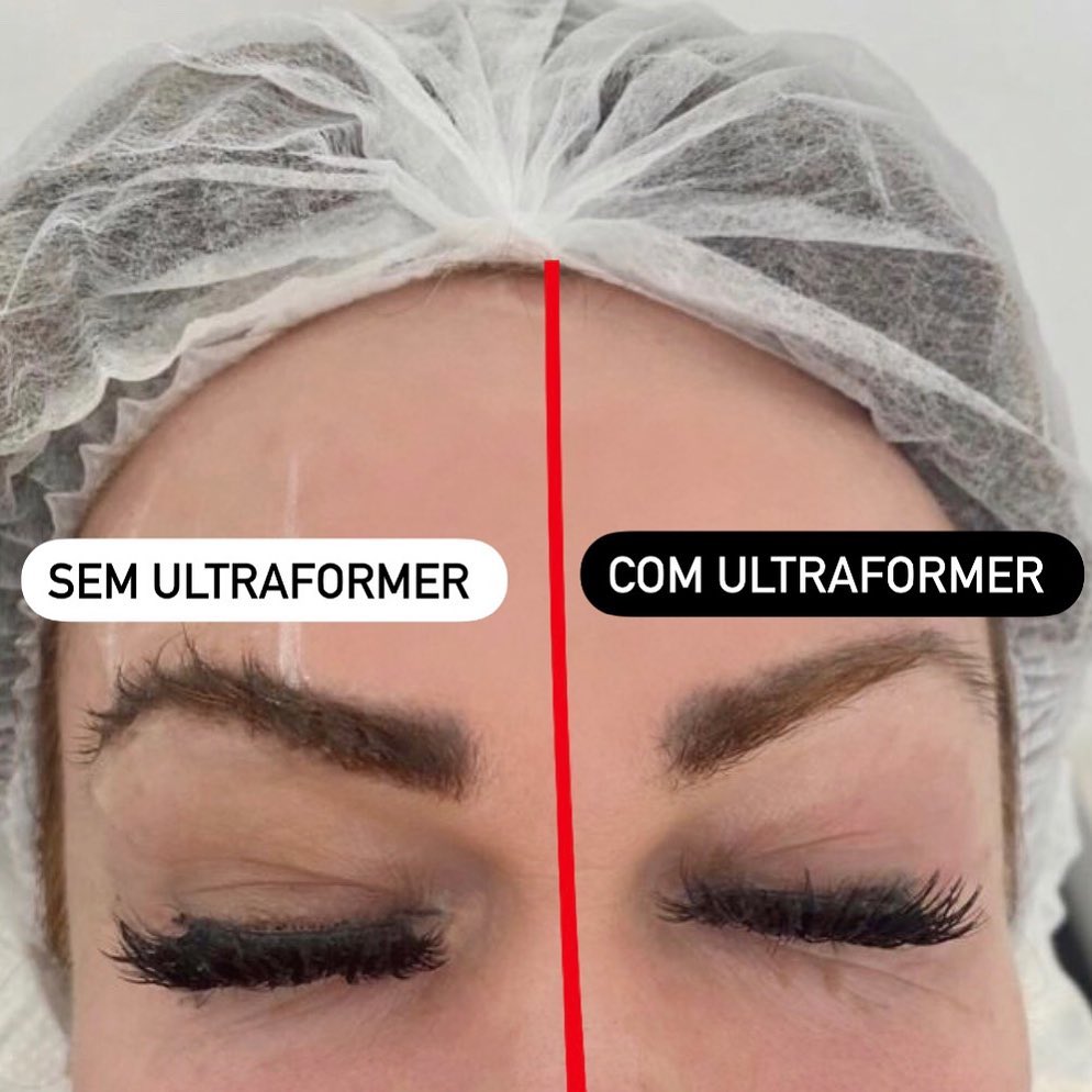 Dra. Cristiane Grosman Ultraformer III #2